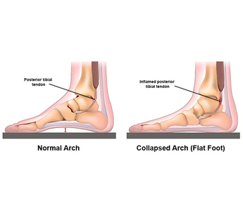 Best Ankle Brace for Posterior Tibial Tendon Dysfunction (PTTD) or Adult Acquired Flat Foot