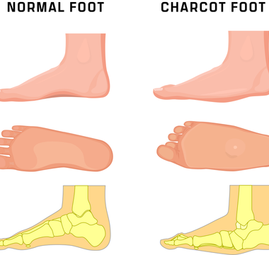 Charcot Neuropathy and the TayCo Medical XAB
